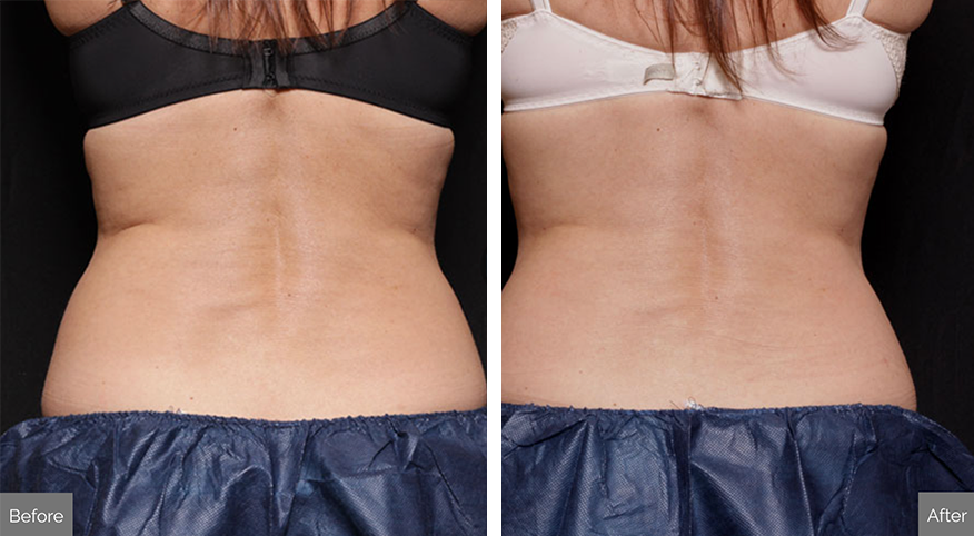 Body Contouring before and after photo. Complete Medical Weight Loss and Anti Aging