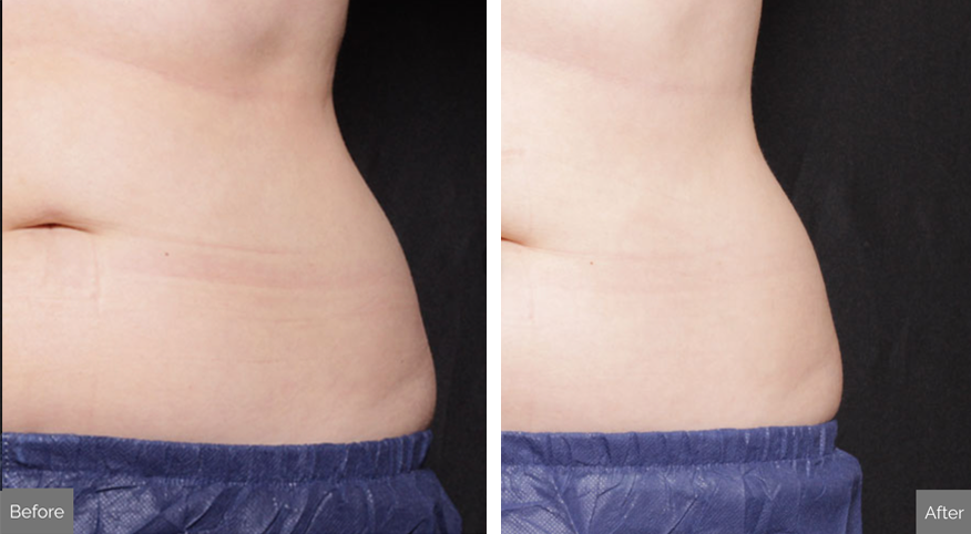 Venus Bliss Max Before and After
