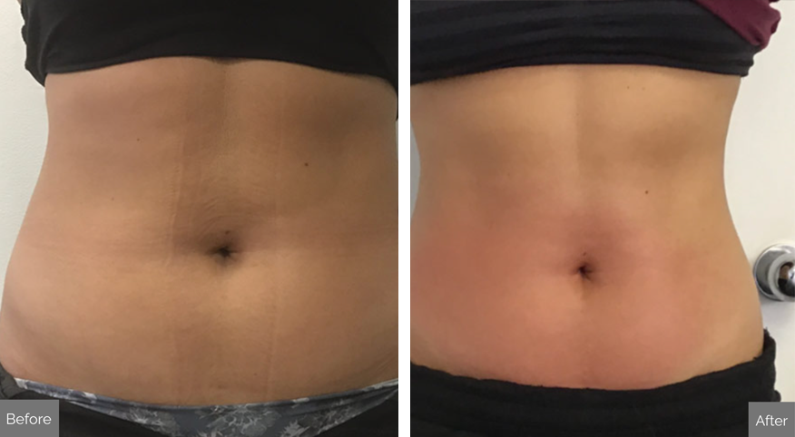 Venus Bliss Max Before and After