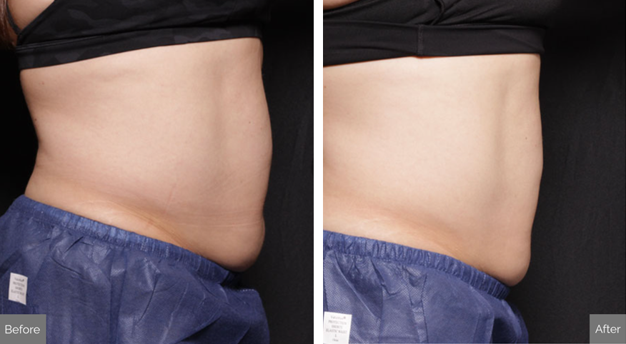 Venus Bliss Max Before and After